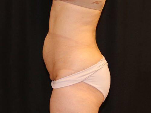 Tummy Tuck  Before & After Image