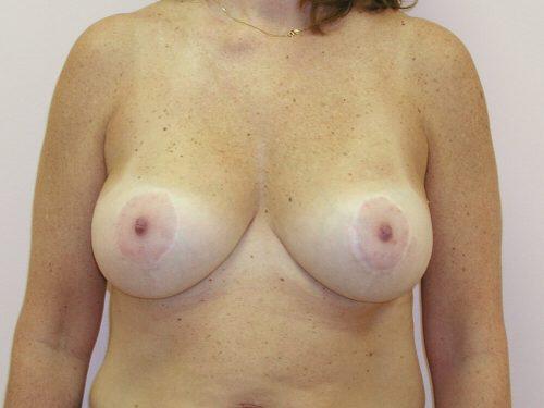 Breast Augmentation With Lift  Before & After Image