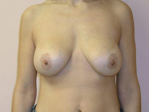 Breast Augmentation With Lift  Before & After Image