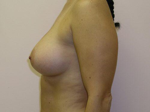 Breast Augmentation  Before & After Image