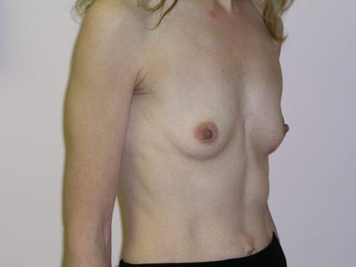 Breast Augmentation  Before & After Image