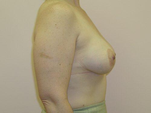 Tuberous Breast Before & After Image