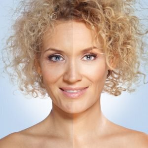 woman before and after chemical peel