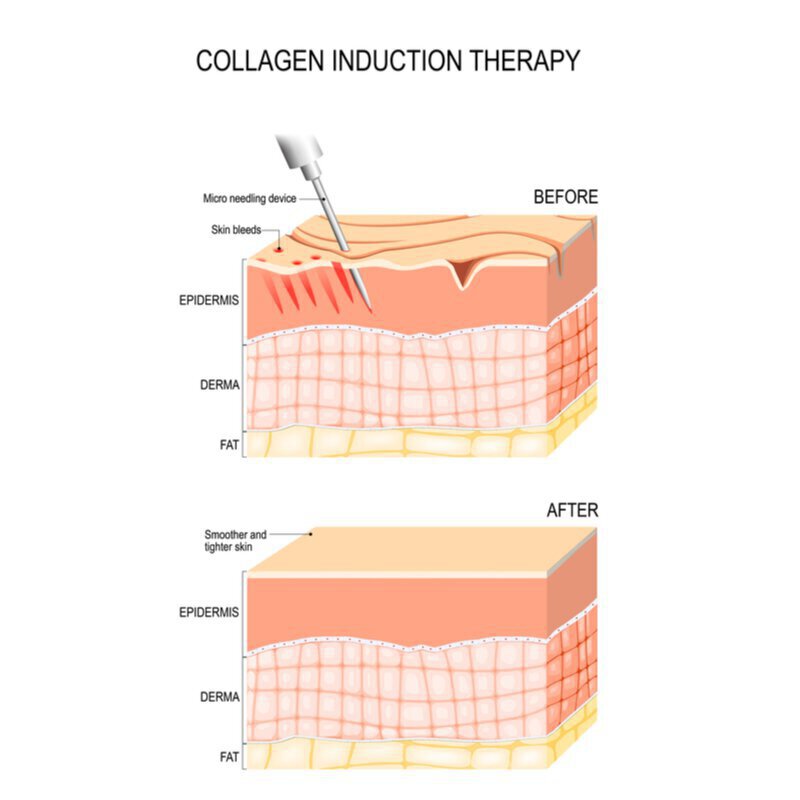 example of collagen induction therapy