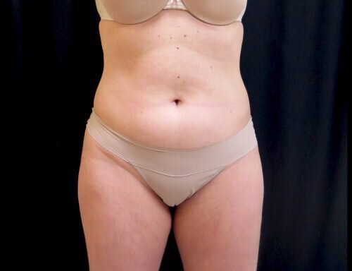 CoolSculpting before picture