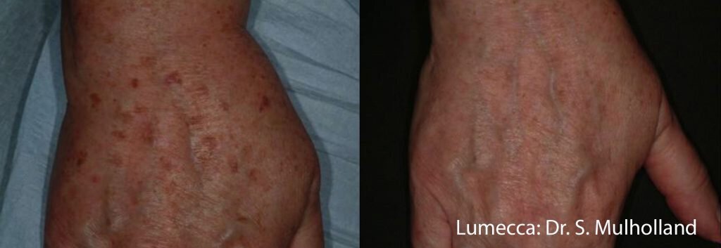 Lumecca before and after 1