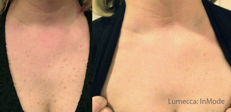 Lumecca before and after 2