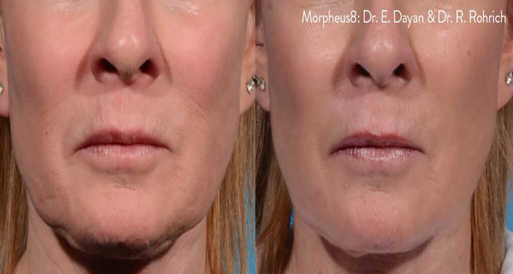 Morpheus8 before and after 1