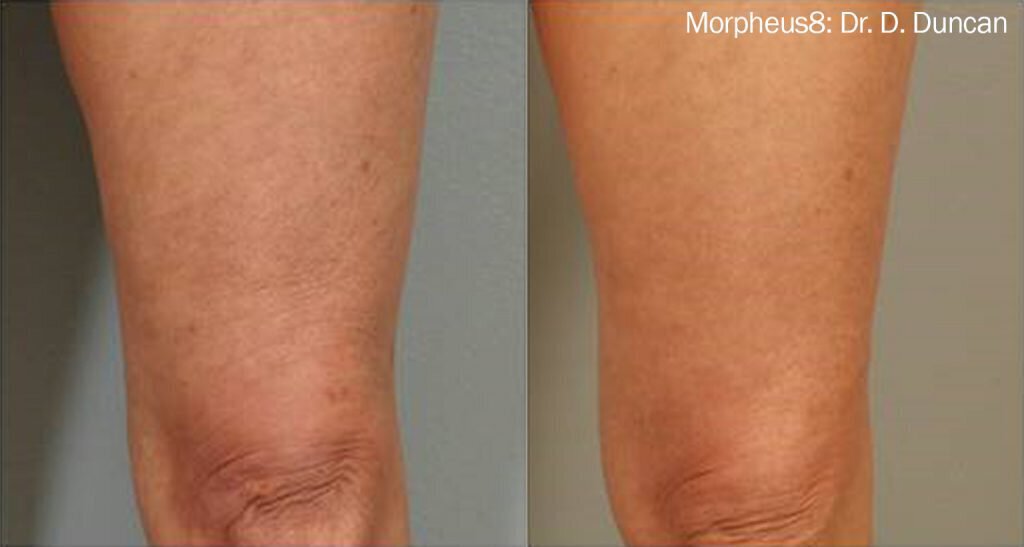 Morpheus8 before and after 2