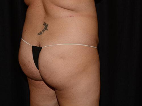 Brazilian Butt Lift  Before & After Image