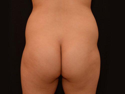 Brazilian Butt Lift  Before & After Image