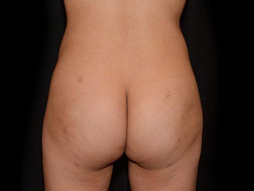 Brazilian Butt Lift  Before & After Image