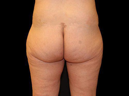 Brazilian Butt Lift  Before & After Image