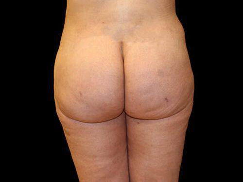 Brazilian Butt Lift  Before & After Image