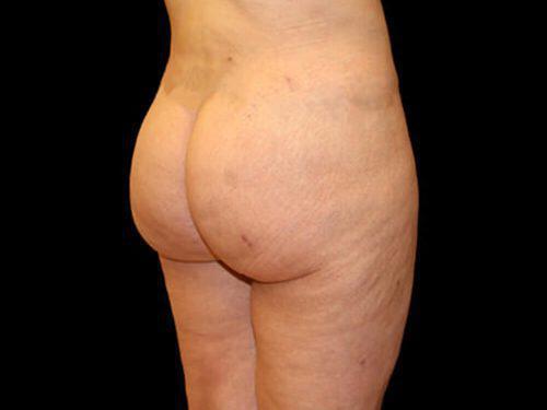 Brazilian Butt Lift  Before & After Image