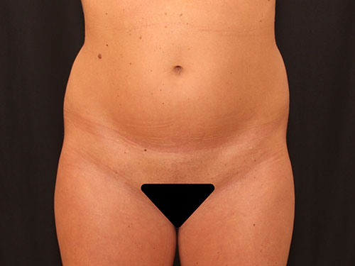 Brazilian Butt Lift  Before & After Image