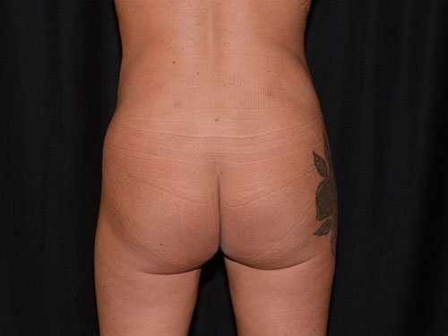 Brazilian Butt Lift  Before & After Image