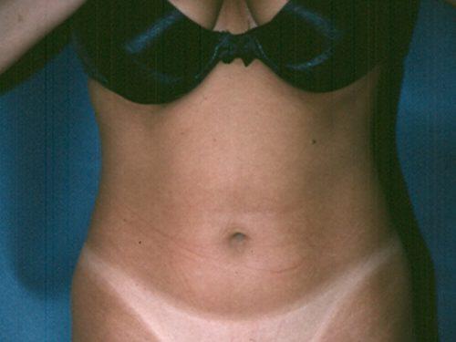 Liposuction  Before & After Image