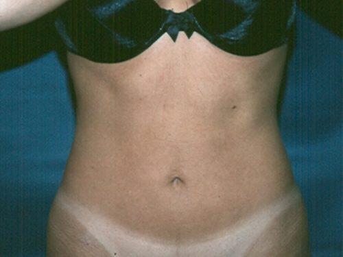 Liposuction  Before & After Image