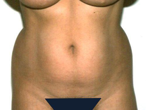 Liposuction  Before & After Image