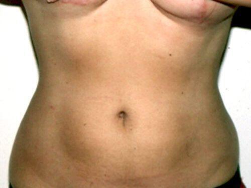 Liposuction  Before & After Image