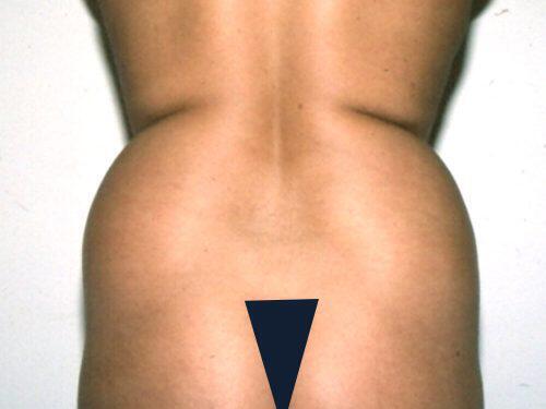 Liposuction  Before & After Image