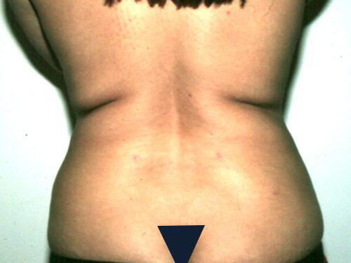 Liposuction  Before & After Image