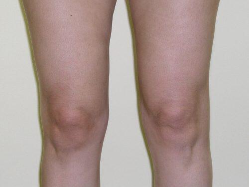 Liposuction  Before & After Image