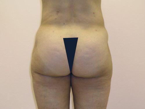 Liposuction  Before & After Image