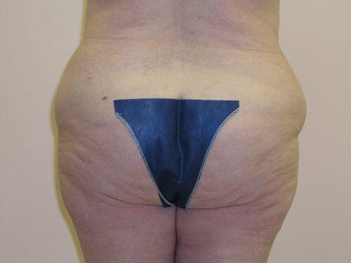 Liposuction  Before & After Image