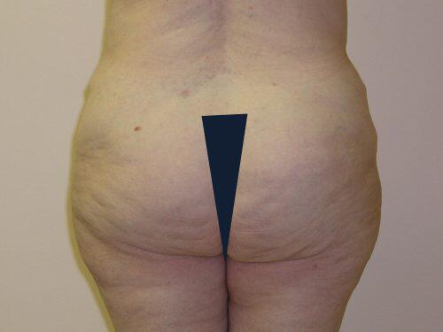 Liposuction  Before & After Image