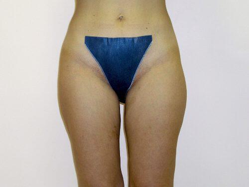 Liposuction  Before & After Image