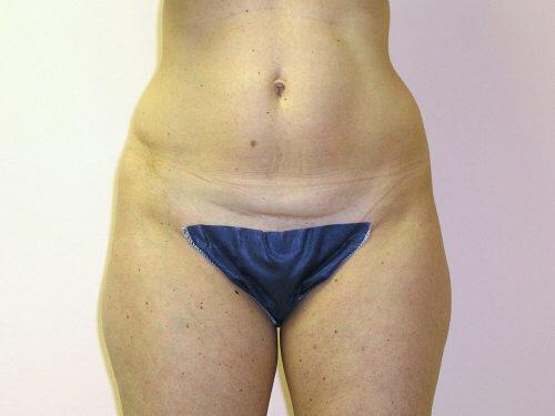 Liposuction  Before & After Image