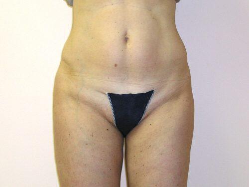 Liposuction  Before & After Image