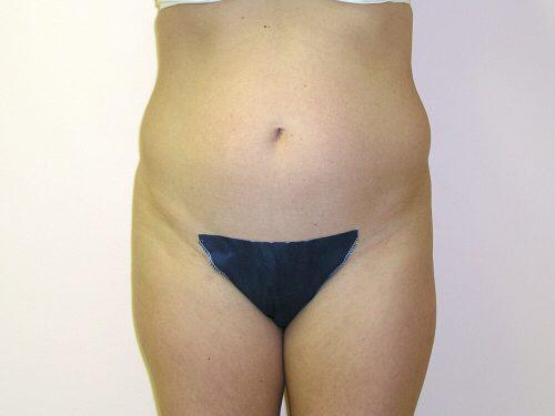 Liposuction  Before & After Image