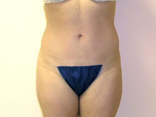 Liposuction  Before & After Image