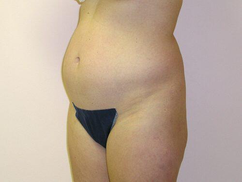 Liposuction  Before & After Image