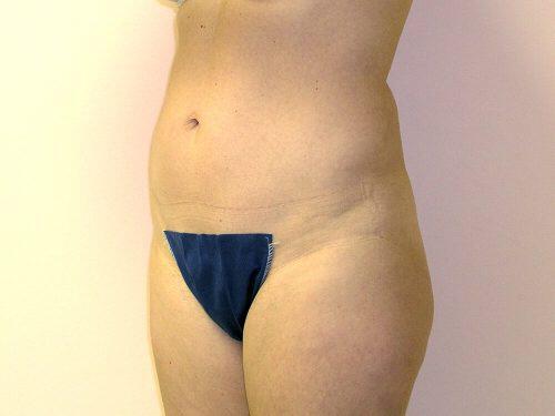 Liposuction  Before & After Image