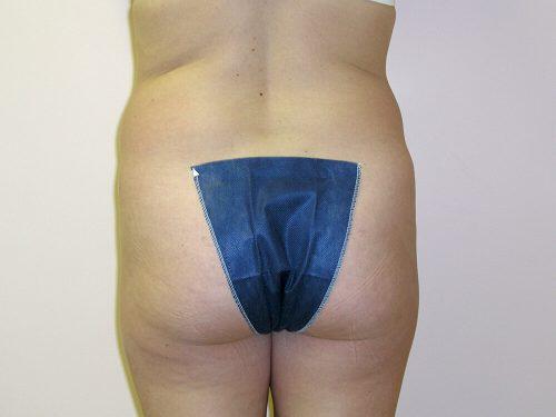 Liposuction  Before & After Image