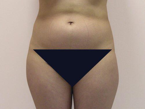 Liposuction  Before & After Image