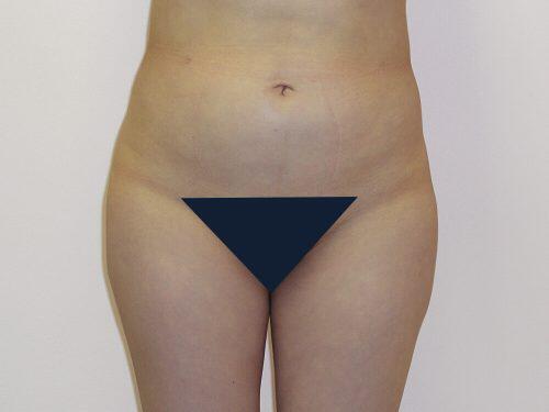 Liposuction  Before & After Image