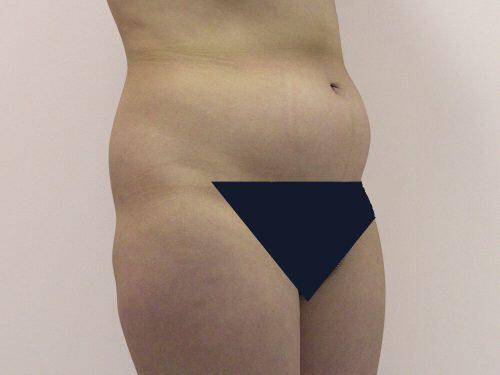 Liposuction  Before & After Image