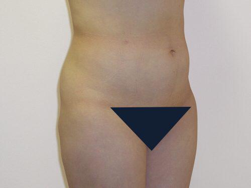 Liposuction  Before & After Image