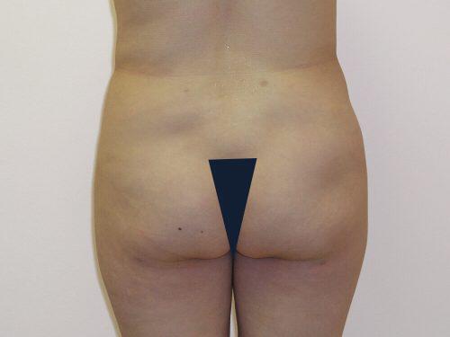 Liposuction  Before & After Image