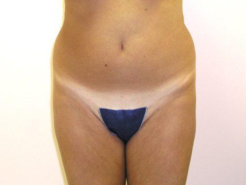 Liposuction  Before & After Image