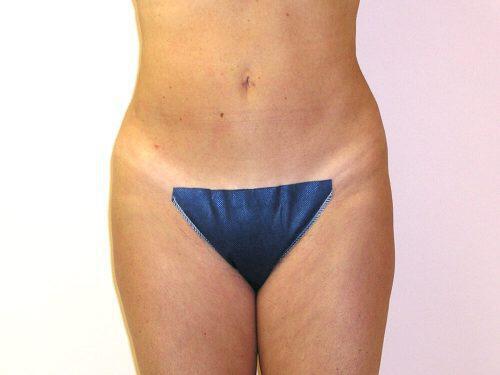 Liposuction  Before & After Image