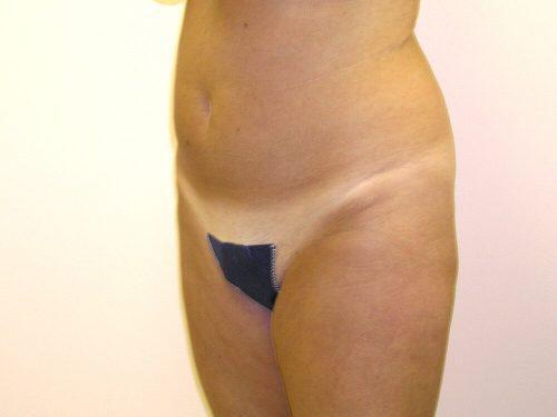 Liposuction  Before & After Image