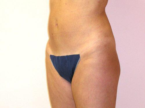 Liposuction  Before & After Image