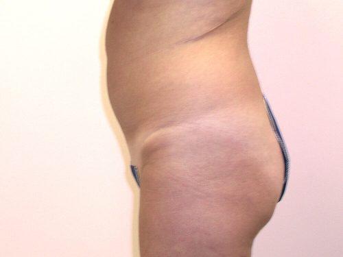 Liposuction  Before & After Image