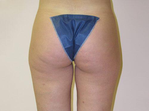 Liposuction  Before & After Image